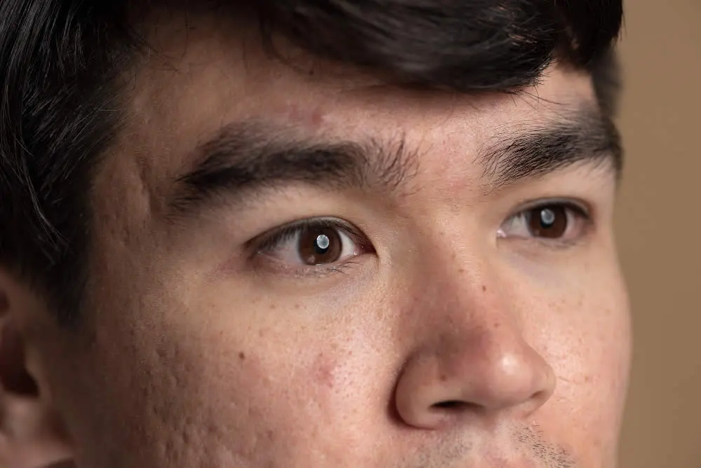 medical dermatology woman close-up-face with acne scars