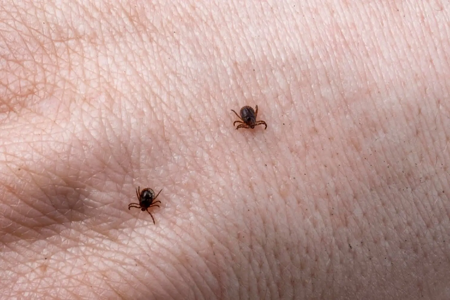 medical dermatology woman mite-male-hand-with-ticks