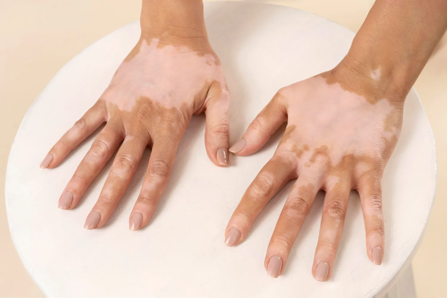 woman-with-vitiligo